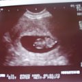 moja fasolka 9 tydz. ciąży #usg #dzidzia #ciąża